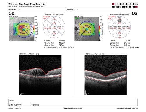 Coats Disease - Parafoveal Telangiectasis Type I - Right Eye
67 year old man with long history of vision loss in the right eye.  Previously treated with laser, avastin.  VA 20/200.
