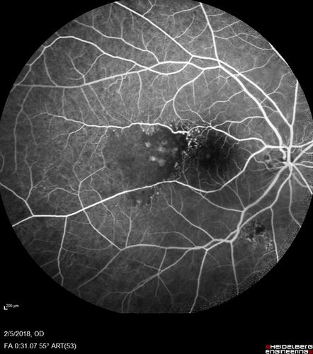 Coats Disease - Parafoveal Telangiectasis Type I - Right Eye
67 year old man with long history of vision loss in the right eye.  Previously treated with laser, avastin.  VA 20/200.
