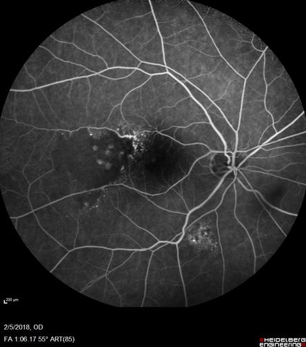 Coats Disease - Parafoveal Telangiectasis Type I - Right Eye
67 year old man with long history of vision loss in the right eye.  Previously treated with laser, avastin.  VA 20/200.
