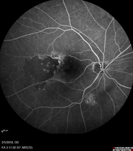 Coats Disease - Parafoveal Telangiectasis Type I - Right Eye
67 year old man with long history of vision loss in the right eye.  Previously treated with laser, avastin.  VA 20/200.
