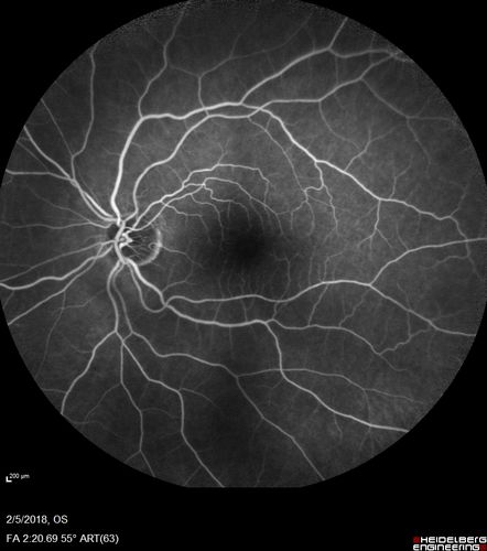 Coats Disease - Parafoveal Telangiectasis Type I - Right Eye
67 year old man with long history of vision loss in the right eye.  Previously treated with laser, avastin.  VA 20/200.

