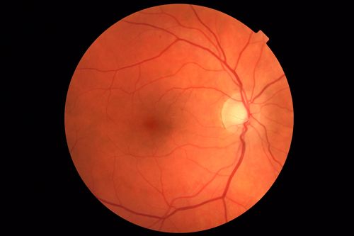 Coats' Disease -51 year old asymptomatic male
20/20 vision - had laser to non-perfusion because of proliferation.
