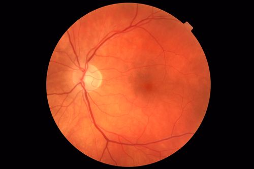 Coats' Disease -51 year old asymptomatic male
20/20 vision - had laser to non-perfusion because of proliferation.
