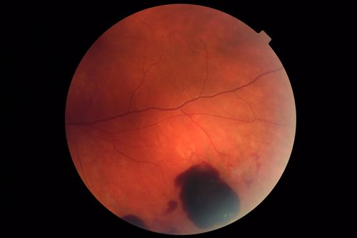 Coats' Disease -51 year old asymptomatic male
20/20 vision - had laser to non-perfusion because of proliferation.
