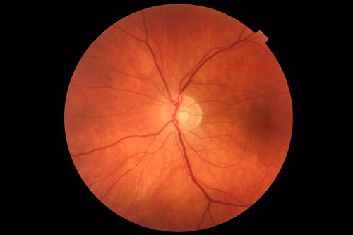 Coats' Disease -51 year old asymptomatic male
20/20 vision - had laser to non-perfusion because of proliferation.

