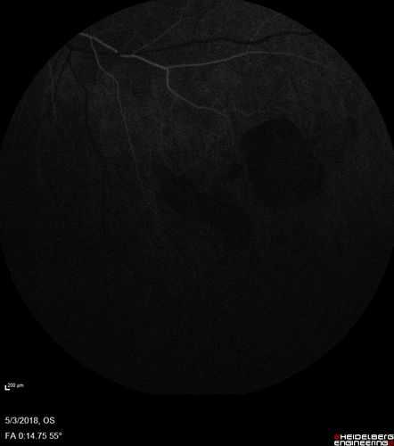 Coats' Disease -51 year old asymptomatic male
20/20 vision - had laser to non-perfusion because of proliferation.
