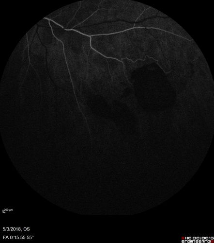 Coats' Disease -51 year old asymptomatic male
20/20 vision - had laser to non-perfusion because of proliferation.
