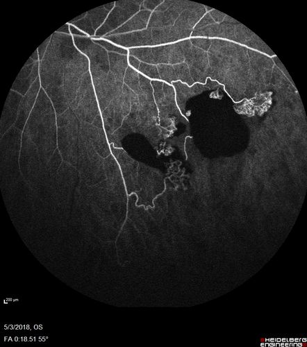 Coats' Disease -51 year old asymptomatic male
20/20 vision - had laser to non-perfusion because of proliferation.
