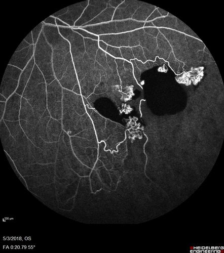 Coats' Disease -51 year old asymptomatic male
20/20 vision - had laser to non-perfusion because of proliferation.
