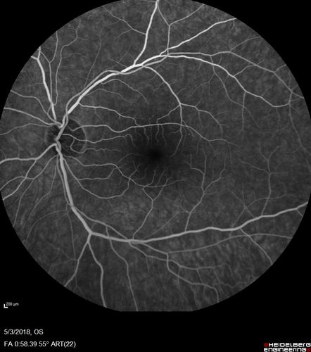Coats' Disease -51 year old asymptomatic male
20/20 vision - had laser to non-perfusion because of proliferation.
