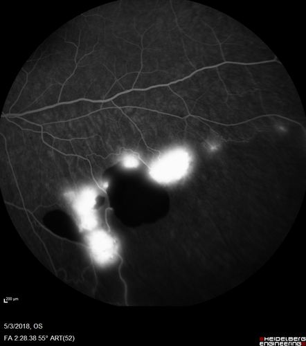Coats' Disease -51 year old asymptomatic male
20/20 vision - had laser to non-perfusion because of proliferation.
