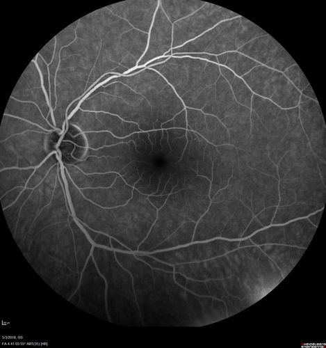 Coats' Disease -51 year old asymptomatic male
20/20 vision - had laser to non-perfusion because of proliferation.
