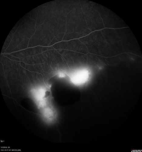 Coats' Disease -51 year old asymptomatic male
20/20 vision - had laser to non-perfusion because of proliferation.
