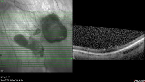 Coats' Disease -51 year old asymptomatic male
20/20 vision - had laser to non-perfusion because of proliferation.
