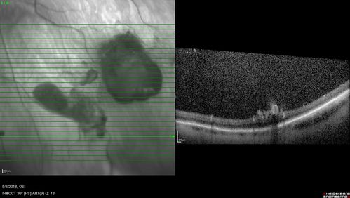 Coats' Disease -51 year old asymptomatic male
20/20 vision - had laser to non-perfusion because of proliferation.
