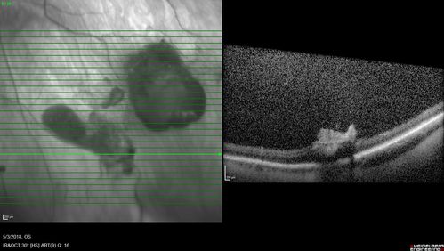 Coats' Disease -51 year old asymptomatic male
20/20 vision - had laser to non-perfusion because of proliferation.
