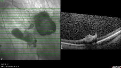 Coats' Disease -51 year old asymptomatic male
20/20 vision - had laser to non-perfusion because of proliferation.
