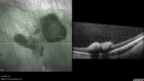 Coats' Disease -51 year old asymptomatic male
20/20 vision - had laser to non-perfusion because of proliferation.
