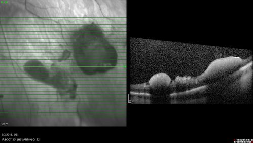 Coats' Disease -51 year old asymptomatic male
20/20 vision - had laser to non-perfusion because of proliferation.
