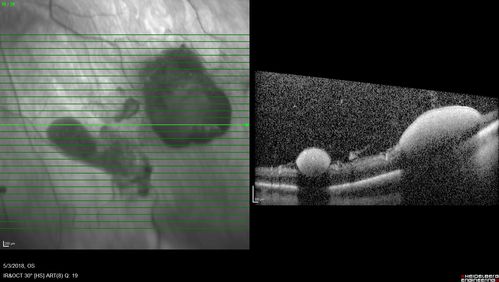 Coats' Disease -51 year old asymptomatic male
20/20 vision - had laser to non-perfusion because of proliferation.
