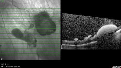 Coats' Disease -51 year old asymptomatic male
20/20 vision - had laser to non-perfusion because of proliferation.
