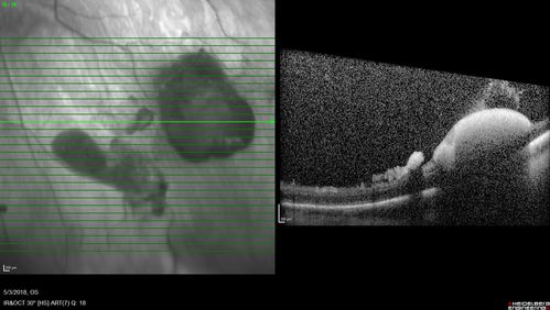 Coats' Disease -51 year old asymptomatic male
20/20 vision - had laser to non-perfusion because of proliferation.

