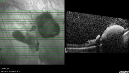 Coats' Disease -51 year old asymptomatic male
20/20 vision - had laser to non-perfusion because of proliferation.
