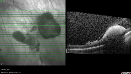 Coats' Disease -51 year old asymptomatic male
20/20 vision - had laser to non-perfusion because of proliferation.

