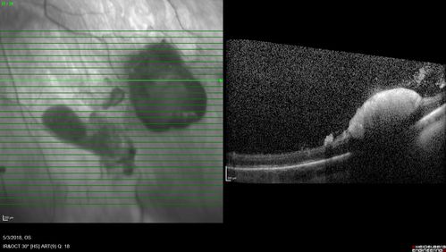 Coats' Disease -51 year old asymptomatic male
20/20 vision - had laser to non-perfusion because of proliferation.
