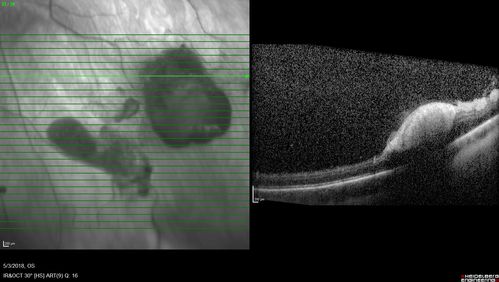 Coats' Disease -51 year old asymptomatic male
20/20 vision - had laser to non-perfusion because of proliferation.
