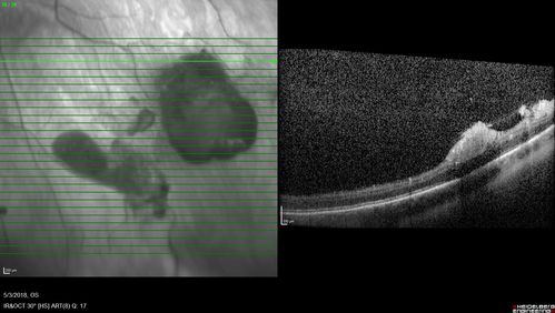 Coats' Disease -51 year old asymptomatic male
20/20 vision - had laser to non-perfusion because of proliferation.
