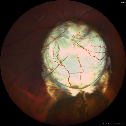 Coloboma - Iris, Lens, Chorioretinal
15 year old with poor vision since birth.  Noticing new flashes in the left eye.  There is an iris - lens coloboma as well.
