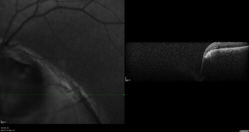 Coloboma - Iris, Lens, Chorioretinal
15 year old with poor vision since birth.  Noticing new flashes in the left eye.  There is an iris - lens coloboma as well.
