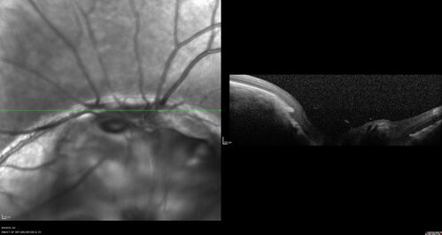 Coloboma - Iris, Lens, Chorioretinal
15 year old with poor vision since birth.  Noticing new flashes in the left eye.  There is an iris - lens coloboma as well.

