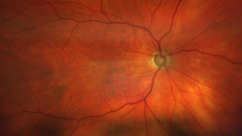 Coloboma - optic nerve, choroid, and retina - left eye
80 year old man with glaucoma in the right eye.  The left eye has a coloboma of the optic nerve, choroid and retina.
VA 20/25 OD, 20/32 OS

