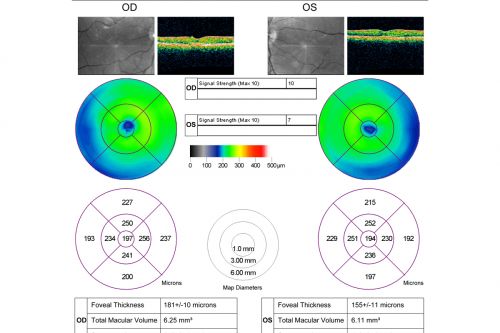 Congenital Achromatopsia 
26-year-old man was diagnosed with congenital achromatopsia by ERG as a child.  He has family members who also have this disorder.   OD 20/200, OS 20/200.
