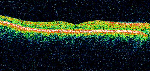 Congenital Achromatopsia 
26-year-old man was diagnosed with congenital achromatopsia by ERG as a child.  He has family members who also have this disorder.   OD 20/200, OS 20/200.
