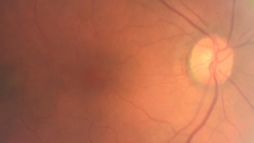 Late Onset Cone Dystrophy - Very Mild
Only IR and OCT show very mild bull's eye.  67 year old female with difficulty seeing in bright light
