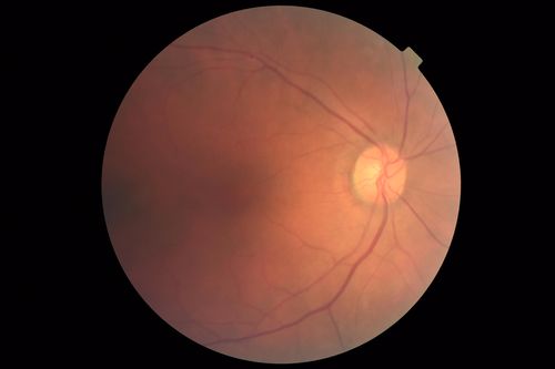 Late Onset Cone Dystrophy - Very Mild
Only IR and OCT show very mild bull's eye.  67 year old female with difficulty seeing in bright light

