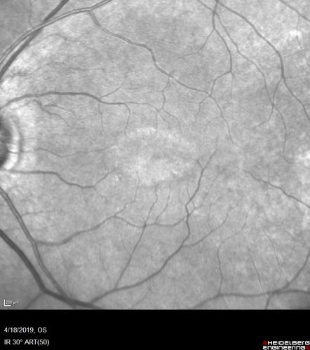 Late Onset Cone Dystrophy - Very Mild
Only IR and OCT show very mild bull's eye.  67 year old female with difficulty seeing in bright light
