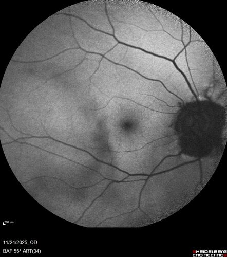 Mild Cone Dystrophy - CRX Mutation
65 year old  female with minimal symptoms and a mild cone dystrophy.
