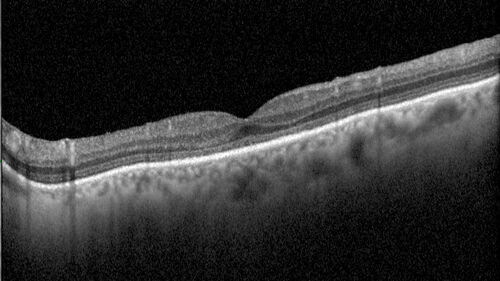 Mild Cone Dystrophy - CRX Mutation
65 year old  female with minimal symptoms and a mild cone dystrophy.
