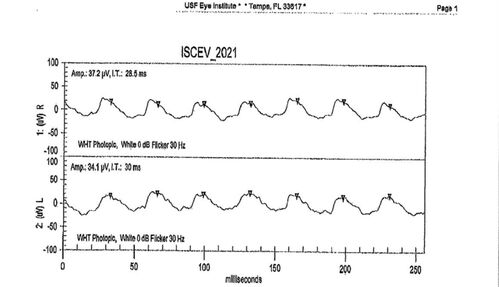 Mild Cone Dystrophy - CRX Mutation
65 year old  female with minimal symptoms and a mild cone dystrophy.
