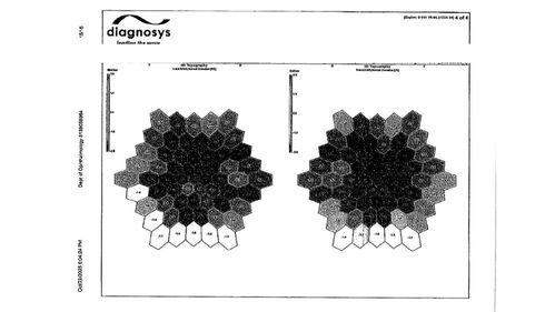Mild Cone Dystrophy - CRX Mutation
65 year old  female with minimal symptoms and a mild cone dystrophy.
