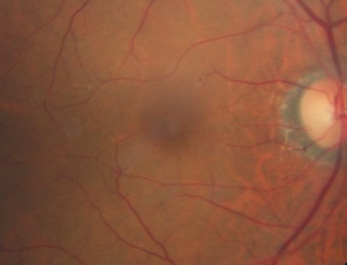 Cone Dystrophy - Autosomal Recessive
74 year old man with 20/25 vision OD and subtle bull's eye on FAF.  Left eye is 20/200 with atrophy of the outer retina centrally
