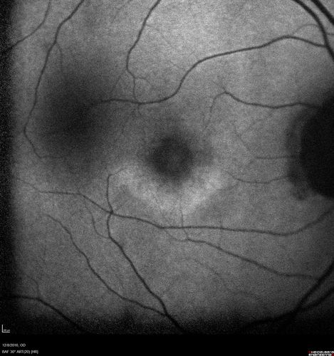 Cone Dystrophy - Autosomal Recessive
74 year old man with 20/25 vision OD and subtle bull's eye on FAF.  Left eye is 20/200 with atrophy of the outer retina centrally
