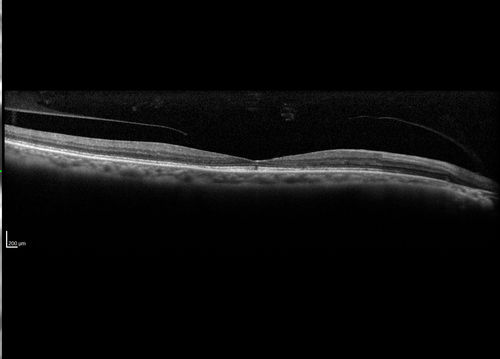 Cone Dystrophy - Autosomal Recessive
74 year old man with 20/25 vision OD and subtle bull's eye on FAF.  Left eye is 20/200 with atrophy of the outer retina centrally
