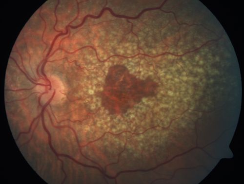Dry AMD - Confluent Drusen Sparing Center of Macula which has Atrophy
65 year old woman, VA 20/40 OD; 20/80 OS.  The center of the macula has few or no drusen with predominantly non-geographic atrophy
