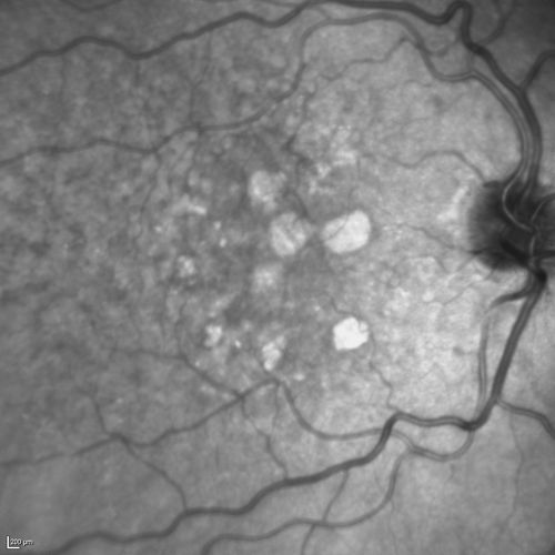 Dry AMD - Confluent Drusen Sparing Center of Macula which has Atrophy
65 year old woman, VA 20/40 OD; 20/80 OS.  The center of the macula has few or no drusen with predominantly non-geographic atrophy
