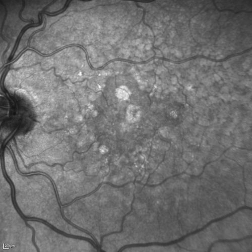 Dry AMD - Confluent Drusen Sparing Center of Macula which has Atrophy
65 year old woman, VA 20/40 OD; 20/80 OS.  The center of the macula has few or no drusen with predominantly non-geographic atrophy
